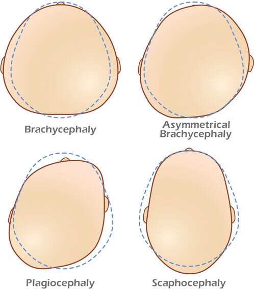 Types of cranial remolding conditions